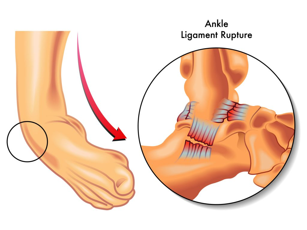 Imagem de torção do tornozelo com ruptura ligamentar