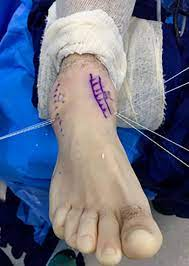 Imagem de reparo artroscópico dos ligamentos mediais e laterais do tornozelo