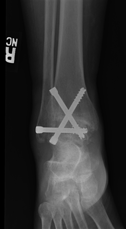 Imagem de uma artrodese do tornozelo