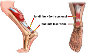 Como saber se o tendão do pé está inflamado?