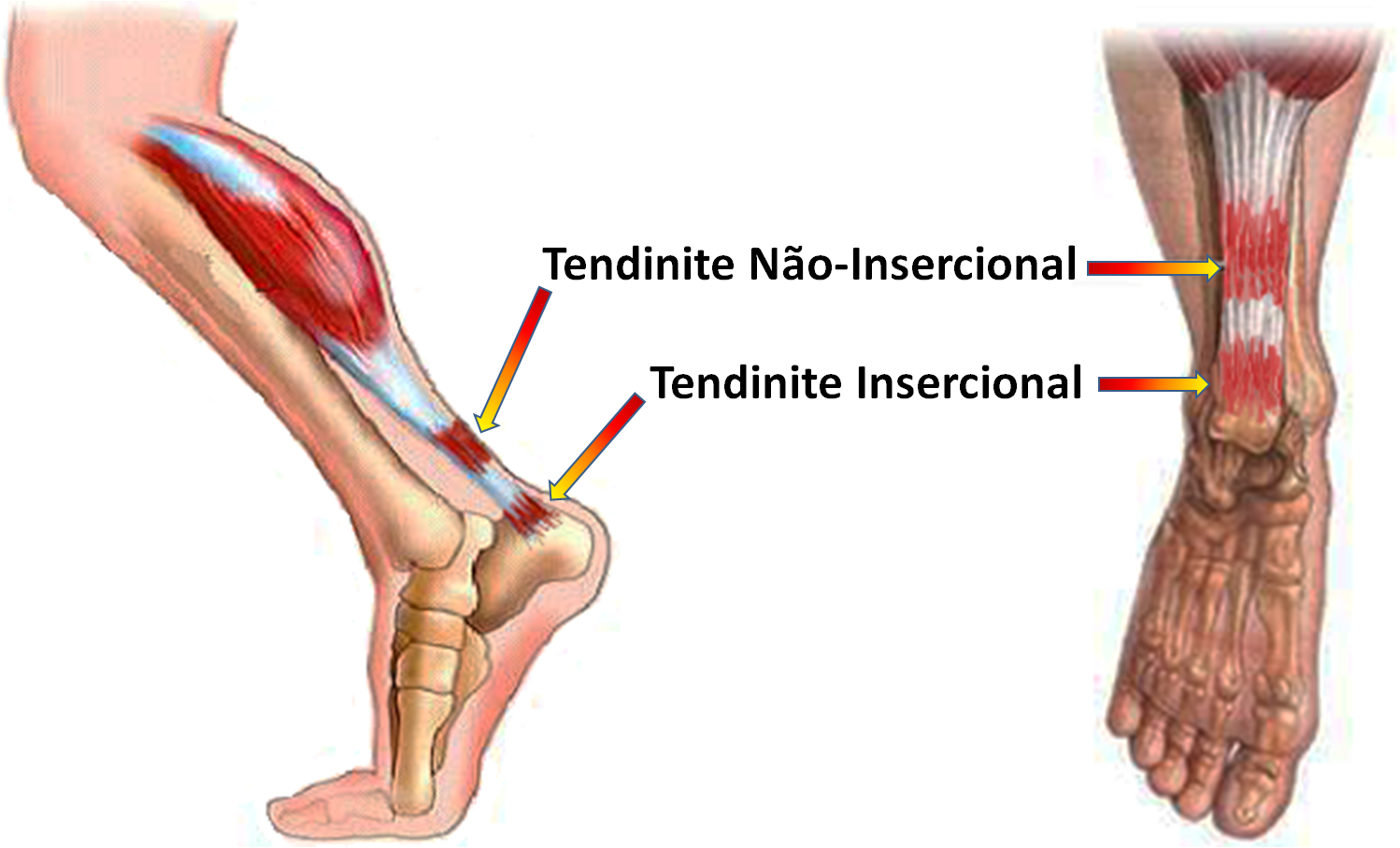 Imagem mostrando dois locais de tendinite no Tendão de Aquiles. A insercional é na junção com o osso e a não insercional um pouco acima.