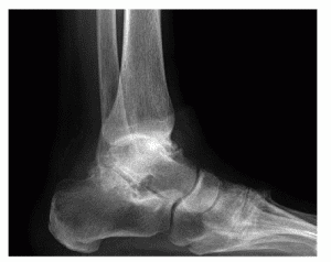 artrose do tornozelo: sintomas, diagnóstico e tratamento