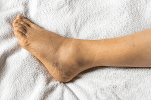 ligamento do tornozelo rompido: tornozelo inchado fotos