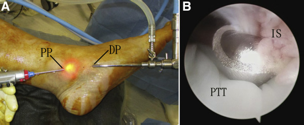 Cirurgia por vídeo para tratamento da tenossinovite do tibial posterior