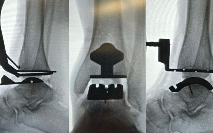 protese de tornozelo feita por dr. tiago baumfeld, cirurgião especialista em pé e tornozelo