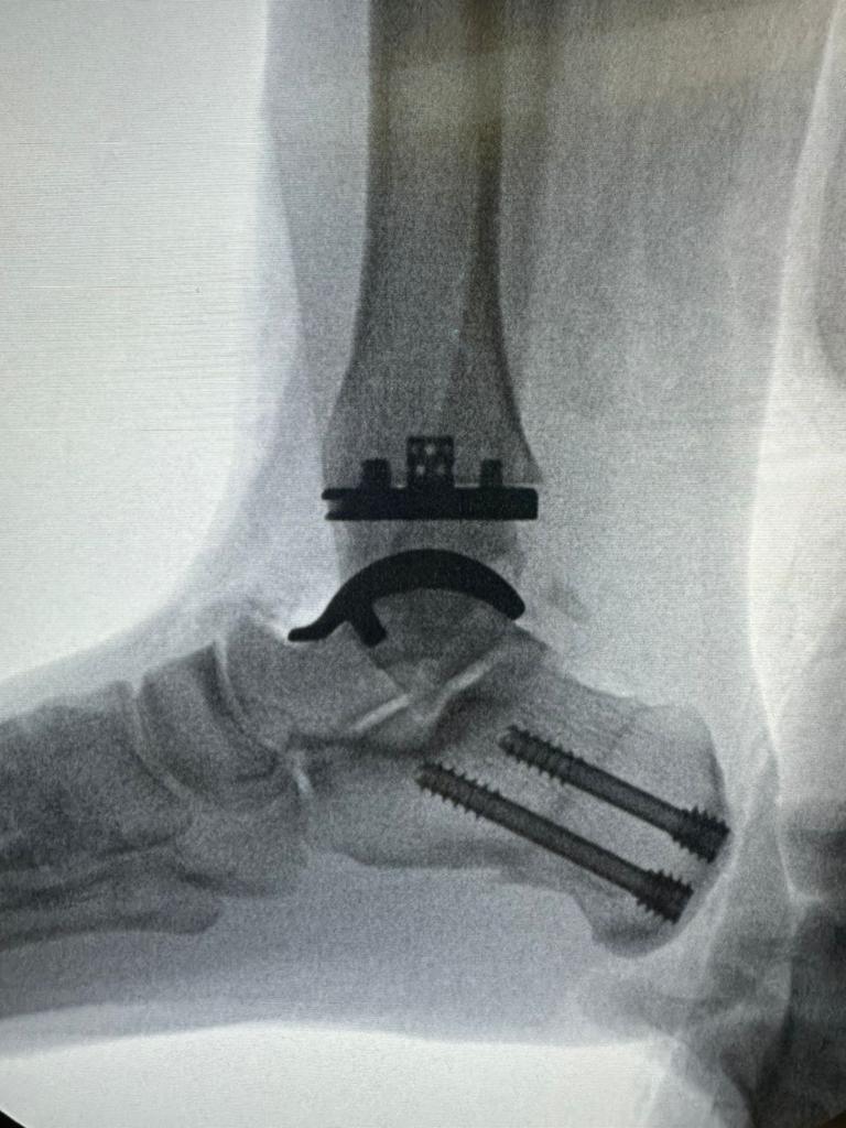 raio x de protese de tornozelo feito pelo dr. tiago baumfeld