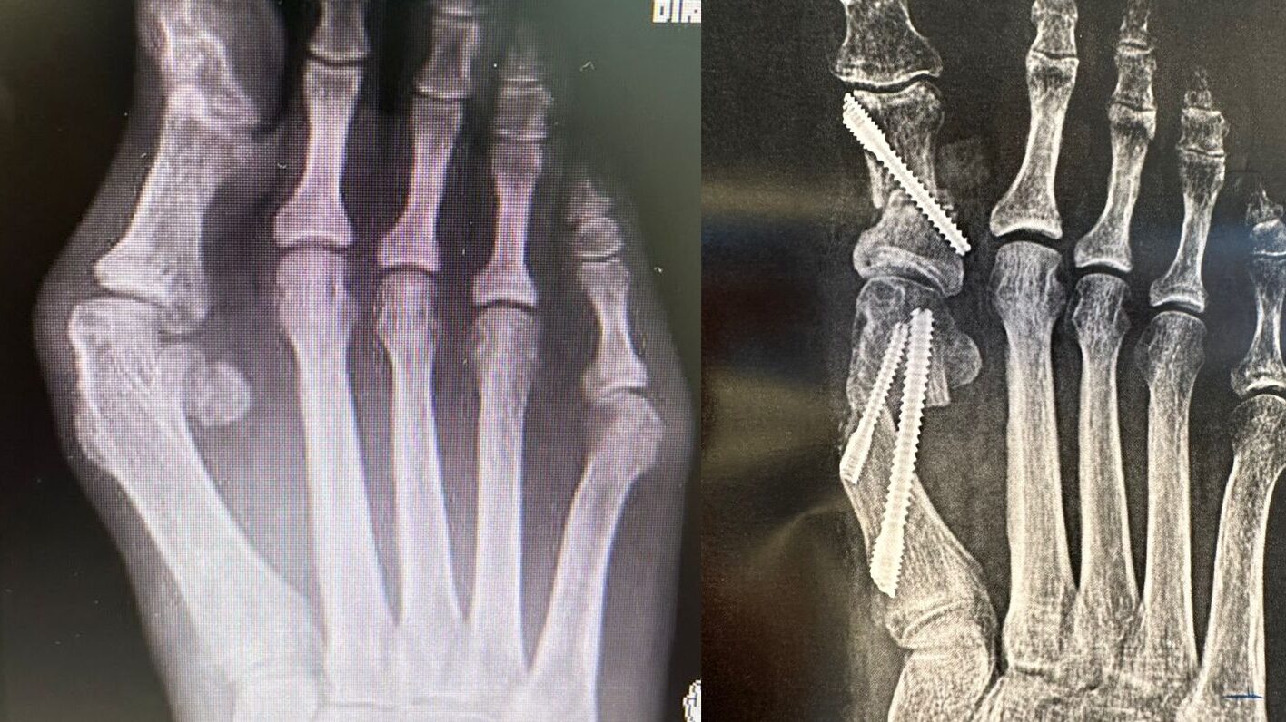 raio x de um antes e depois de cirurgia de retirada de joanete feito pelo dr tiago baumfeld 