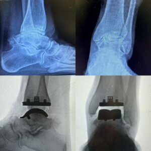 protese de tornozelo feita pelo dr. tiago baumfeld, antes e depois da cirurgia de protese de tornozelo.
