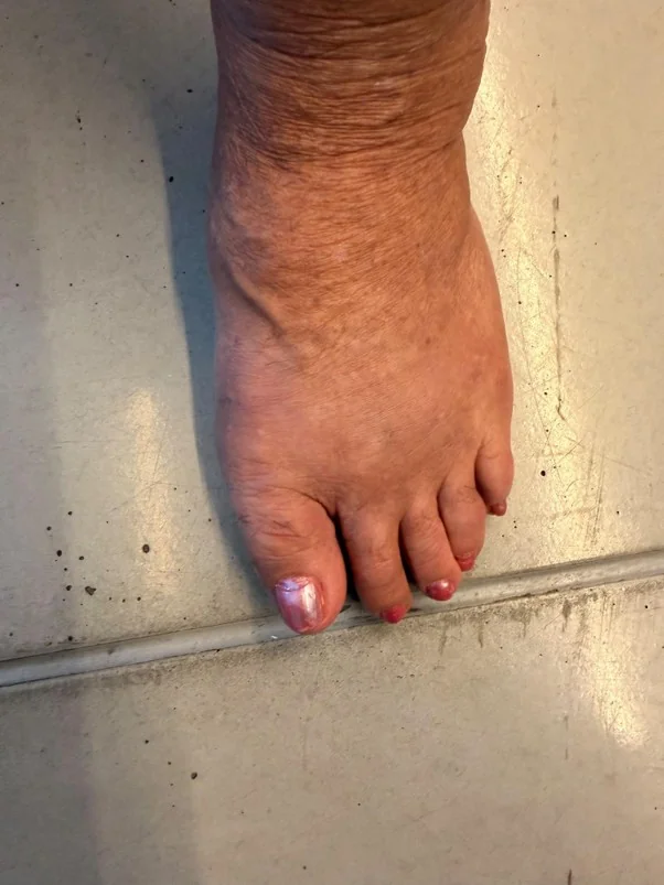 Correção do pé com Hallux Valgus foto acima mostra o pé após a cirurgia