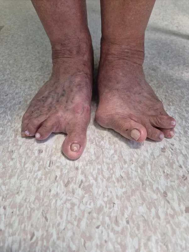 Pé com Hallux Valgus foto acima mostra o pé antes da cirurgia