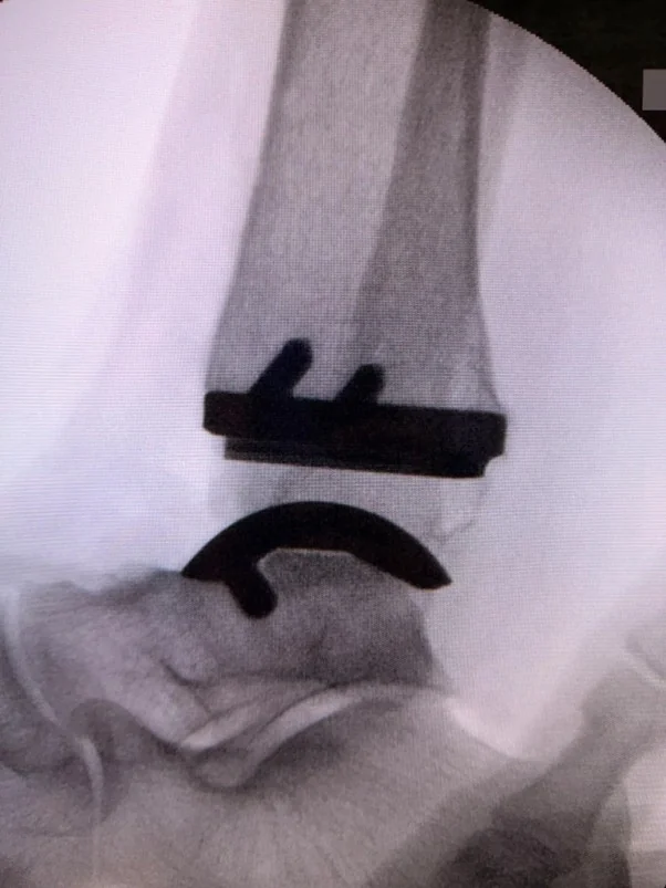 Raio-X mostrando a prótese do tornozelo implantada