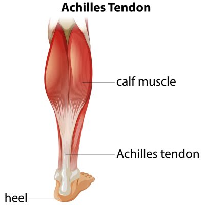 Infográfico médico da ilustração do tendão de Aquiles