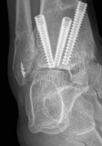 Exemplo de artrodese realizada com 3 parafusos